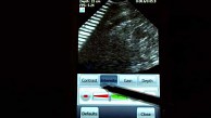 Smartphone als Ultraschallgerät